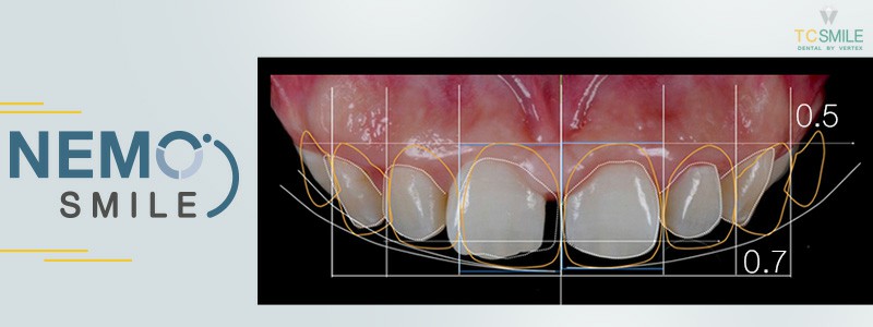ภาพการออกแบบฟัน ด้วยวีเนียร์ เพื่อทำการออกแบบรอยยิ้ม Nemo Smile