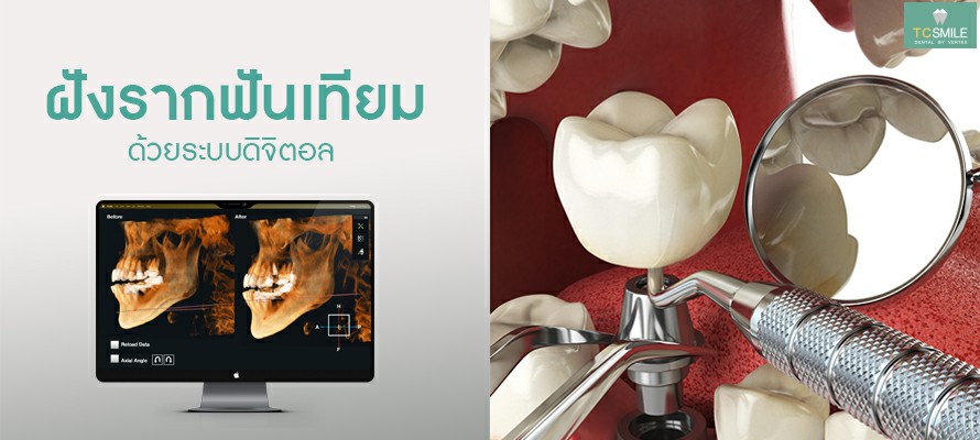 รากฟันเทียมดิจิตอล รากเทียมดิจิตอล รากฟันเทียมระบบดิจิตอล