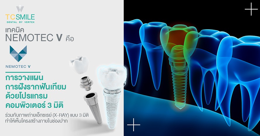 วางแผนการทำ รากฟันเทียม ด้วยระบบคอมพิวเตอร์ 3 มิติ