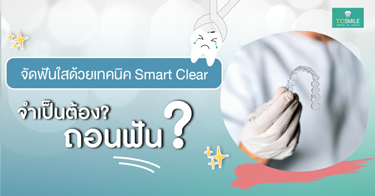 การจัดฟันแบบใส