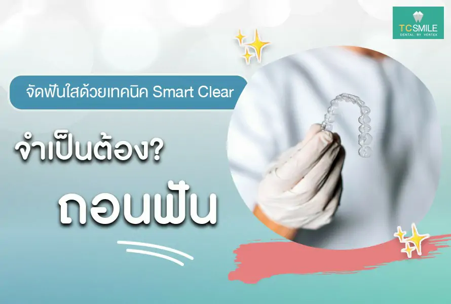 จัดฟันใส smart clear
