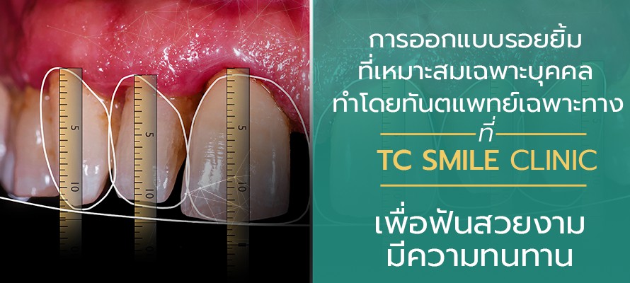 ออกแบบรอยยิ้ม Nemo Smile ที่ TC Smile