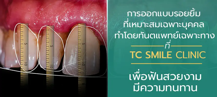 ออกแบบรอยยิ้ม Nemo Smile ที่ TC Smile