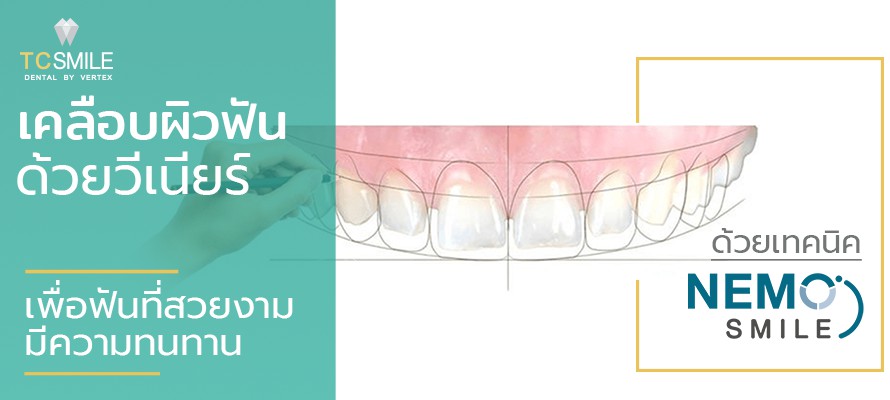 ออกแบบวีเนียร์ด้วยเทคนิค Nemo Smile แปะฟันขาวแก้ฟันเหลือง ฟันแตกบิ่น
