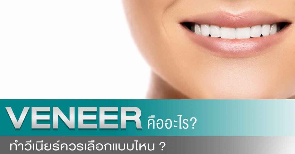 ceramic-composite-veneer