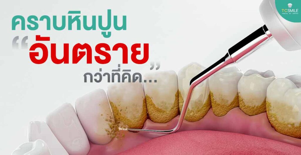 dental-tartar-tooth