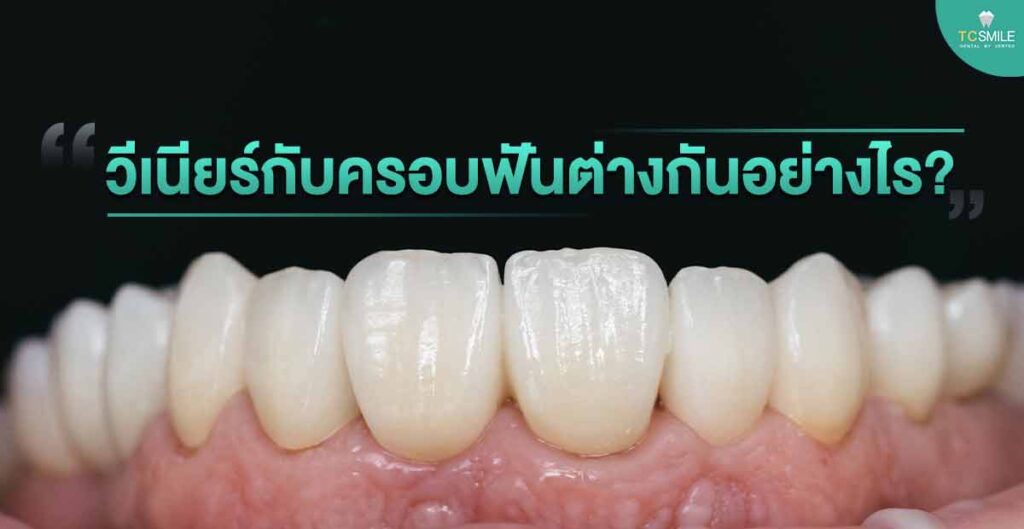 veneer-crown-tooth