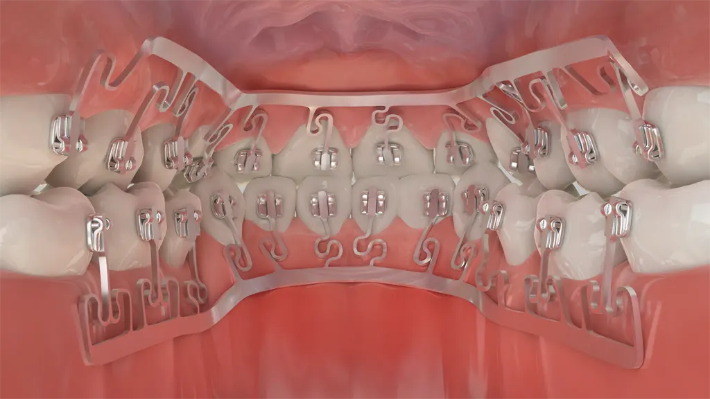 BRIUS Behind the Teeth