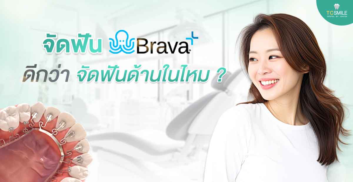 จัดฟันด้านใน