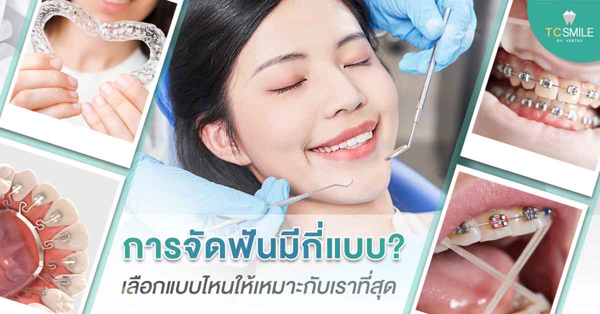 การจัดฟันมีกี่แบบ? เลือกแบบไหนให้เหมาะกับเราที่สุด