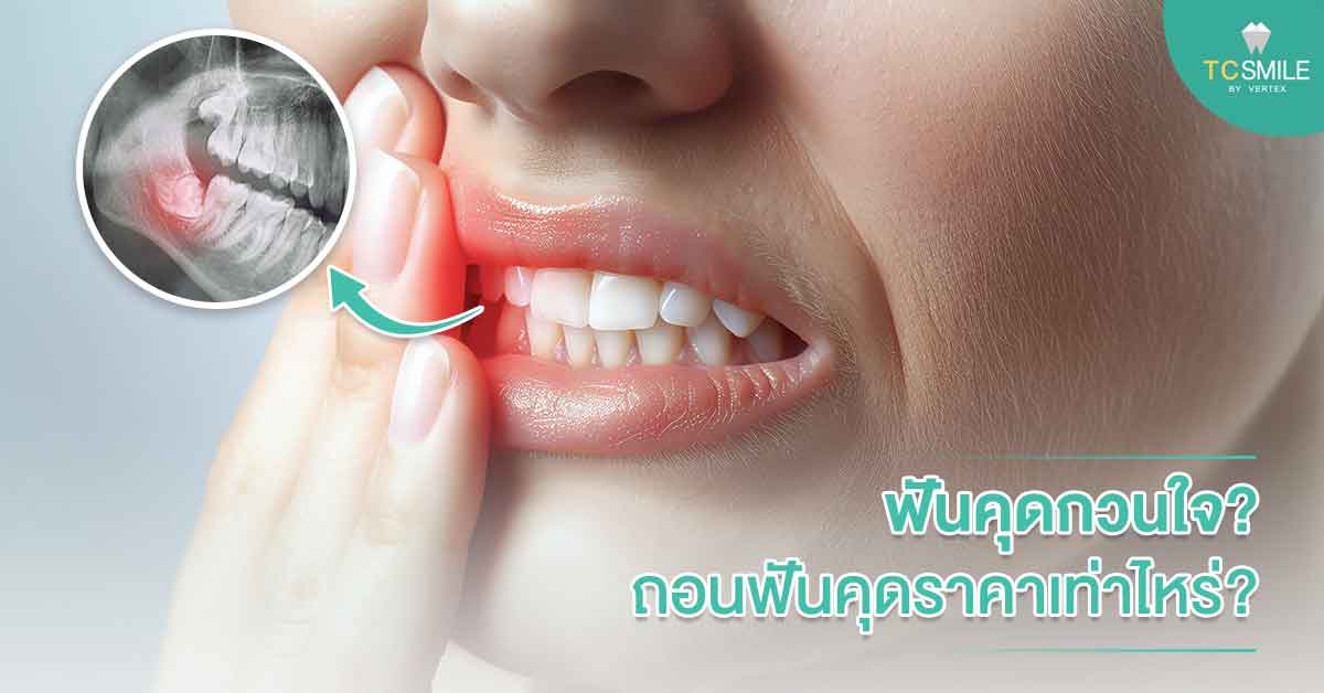 ฟันคุดกวนใจ? ถอนฟันคุดราคาเท่าไหร่?