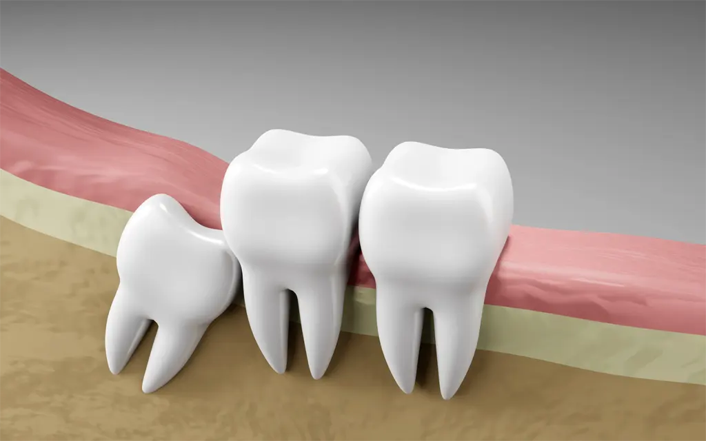 wisdom-tooth-impaction-oral-health-dental-inspection-teeth-medical-dentist