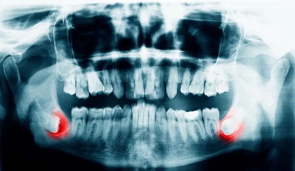 xray-scan-teeth