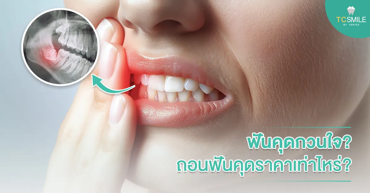ถอนฟันคุดราคา