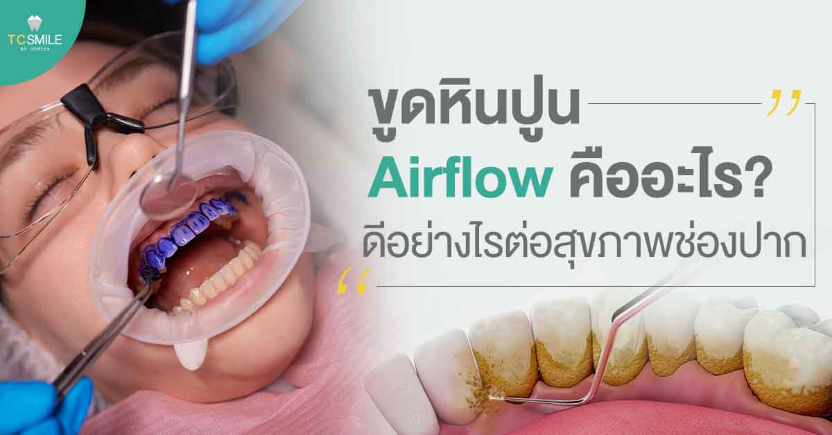 ขูดหินปูนแบบ Airflow คืออะไร? ดีอย่างไรต่อสุขภาพช่องปาก