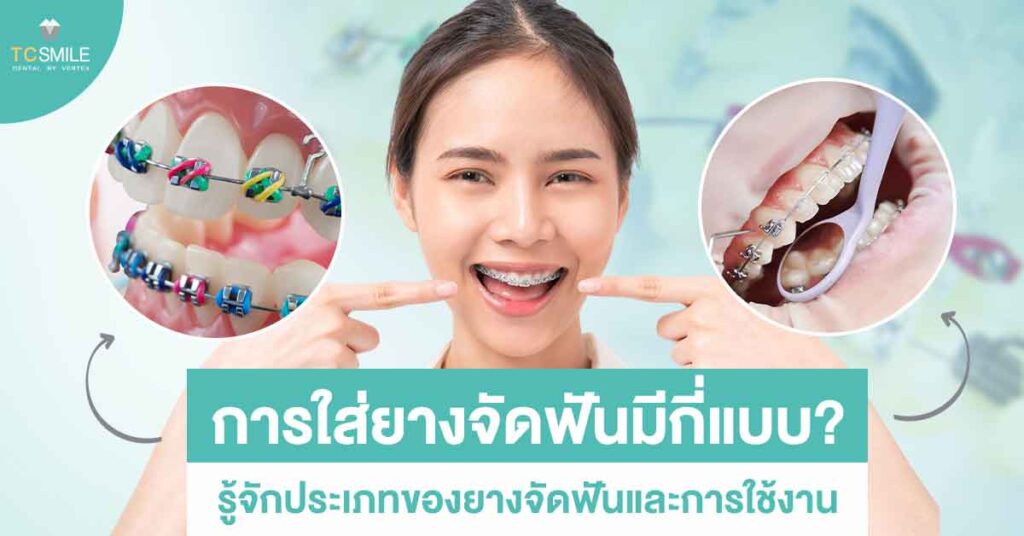 การใส่ยางจัดฟันมีกี่แบบ