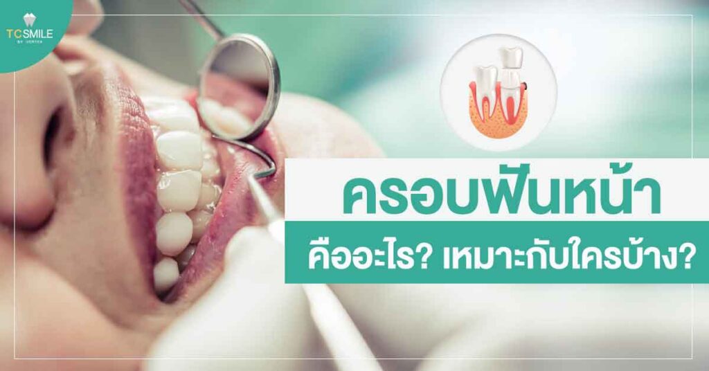 ครอบฟันหน้าคืออะไร