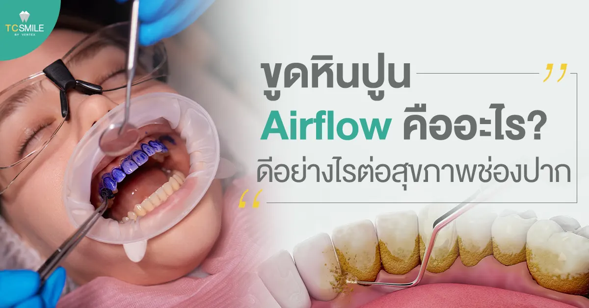 ขูดหินปูนแบบ Airflow คืออะไร? ดีอย่างไรต่อสุขภาพช่องปาก