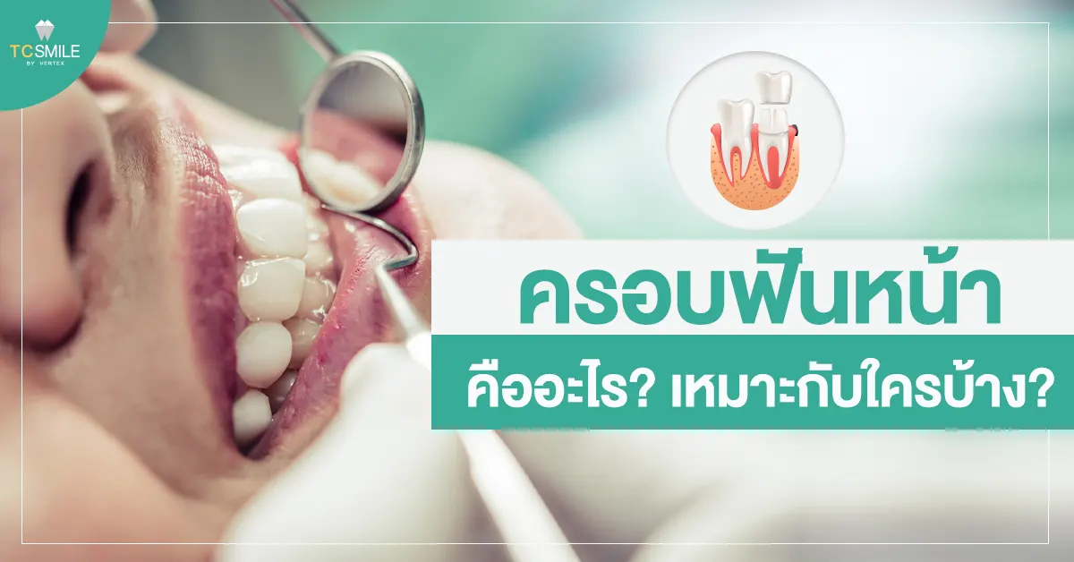 ครอบฟันหน้าคืออะไร