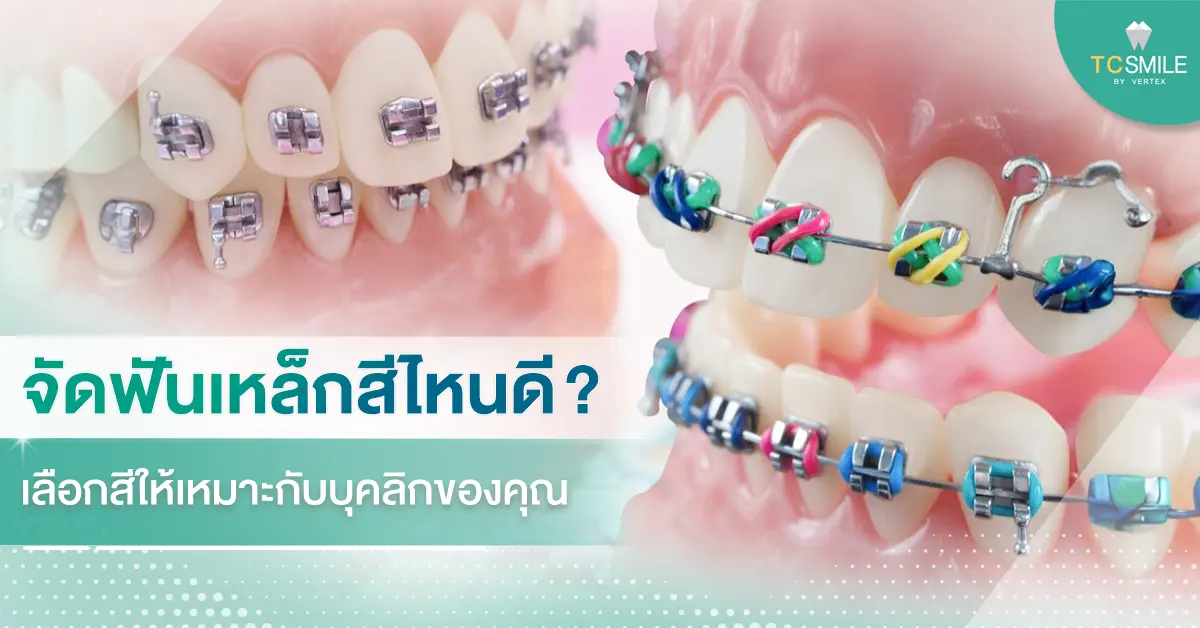 จัดฟันเหล็กสีไหนดี