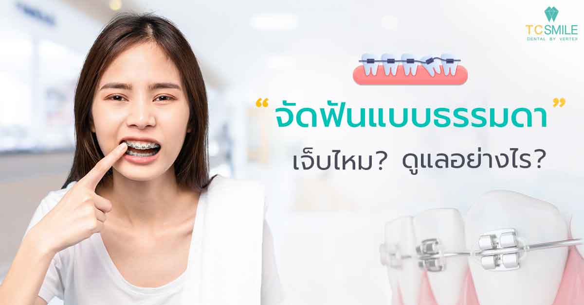 จัดฟันแบบธรรมดา