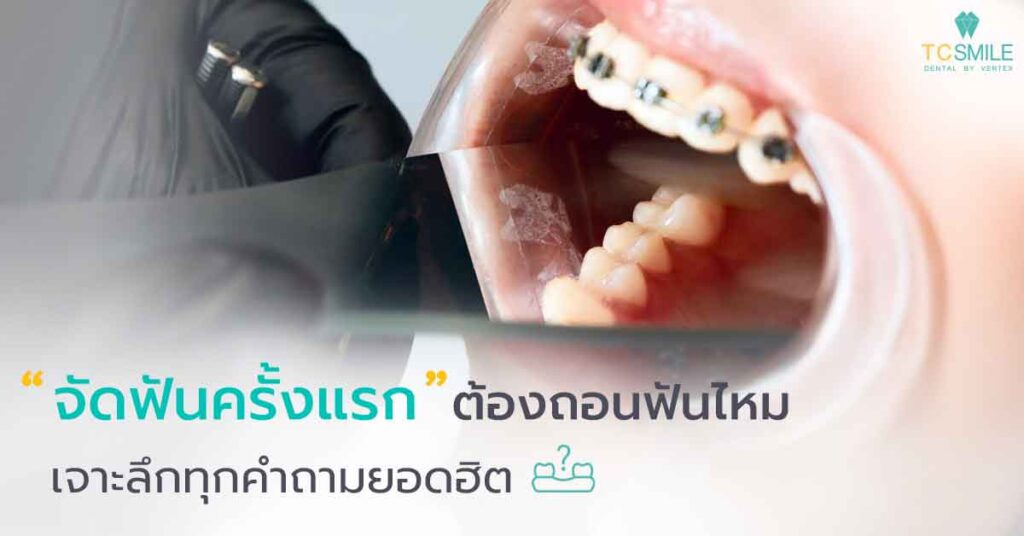 จัดฟันครั้งแรกต้องถอนฟันไหม
