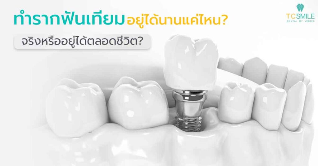 ทำรากฟันเทียมอยู่ได้นานแค่ไหน