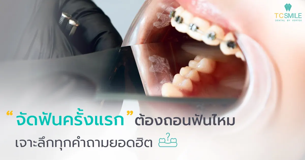 จัดฟันครั้งแรกต้องถอนฟันไหม
