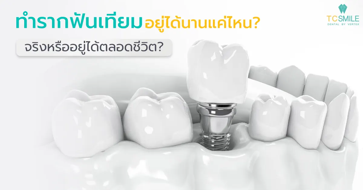 ทำรากฟันเทียมอยู่ได้นานแค่ไหน