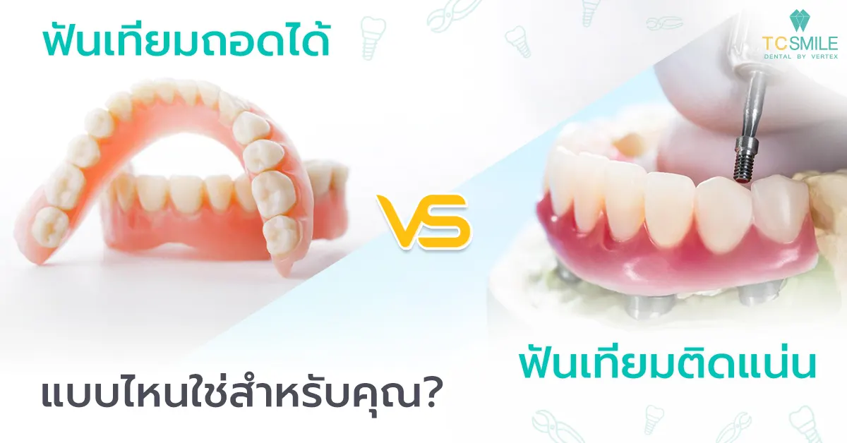 ฟันเทียมถอดได้ vs ฟันเทียมติดแน่น