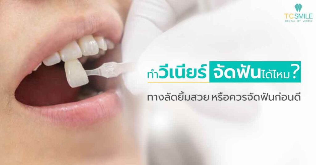 ทําวีเนียร์จัดฟันได้ไหม