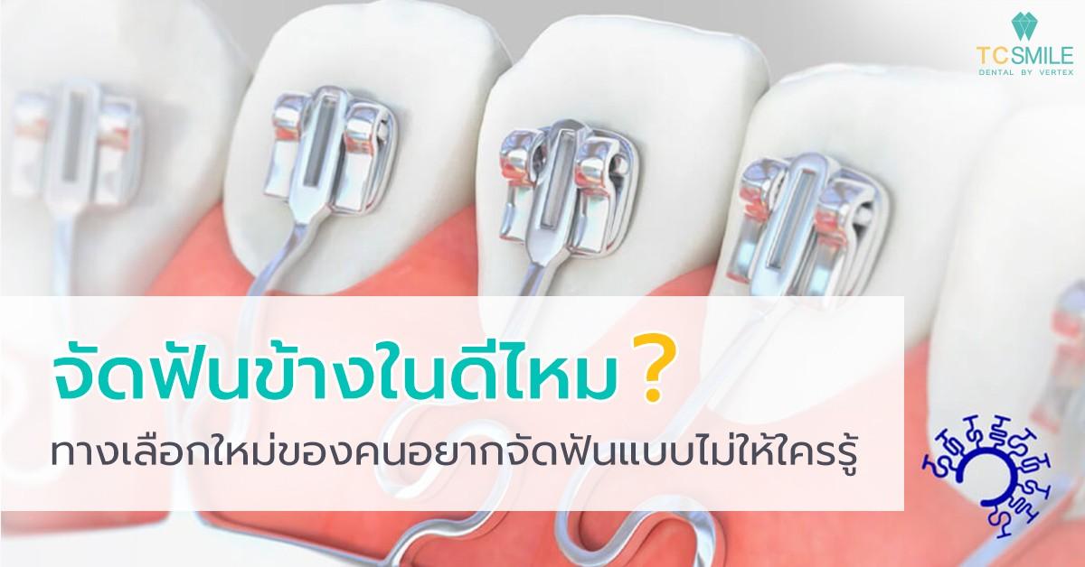 จัดฟันข้างในดีไหม ทางเลือกใหม่ของคนอยากจัดฟันแบบไม่ให้ใครรู้