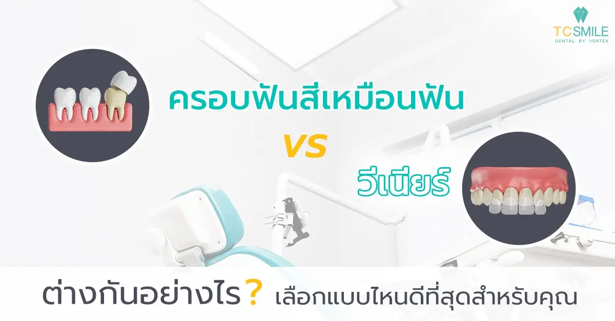 ครอบฟันสีเหมือนฟัน
