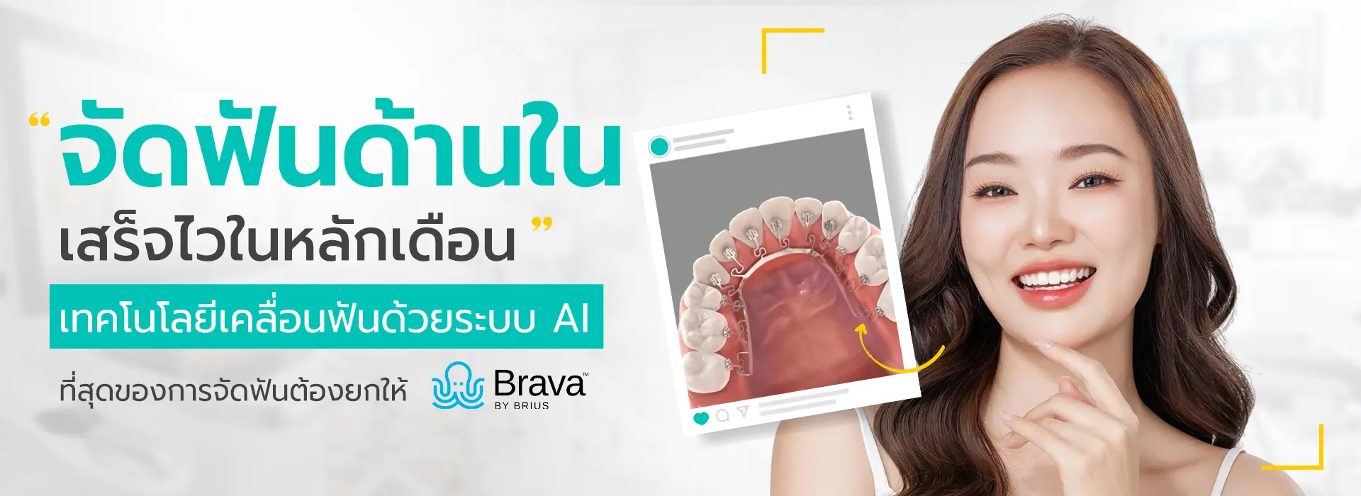 slide จัดฟันใส