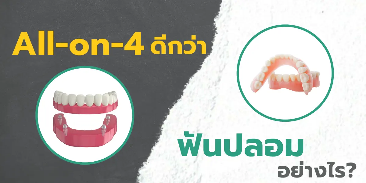 All-on-4 ดีกว่าฟันปลอมธรรมดาอย่างไร