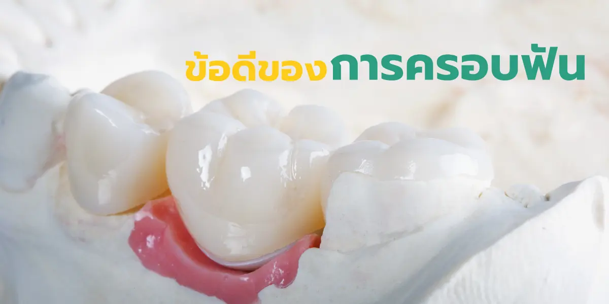 ข้อดีของการครอบฟัน