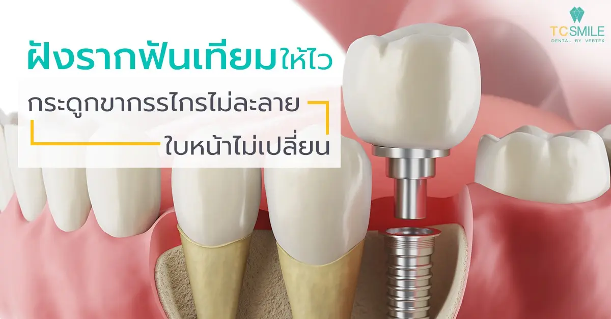 ฝังรากฟันเทียมให้ไว กระดูกขากรรไกรไม่ละลาย ใบหน้าไม่เปลี่ยน