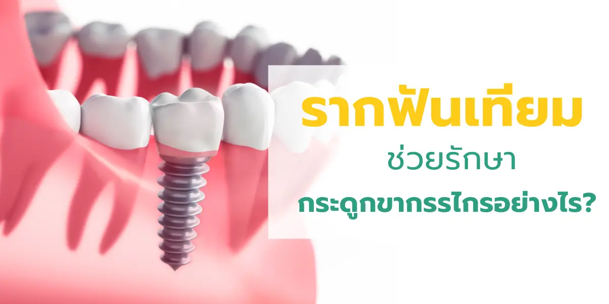 รากฟันเทียมช่วยรักษากระดูกขากรรไกรอย่างไร?