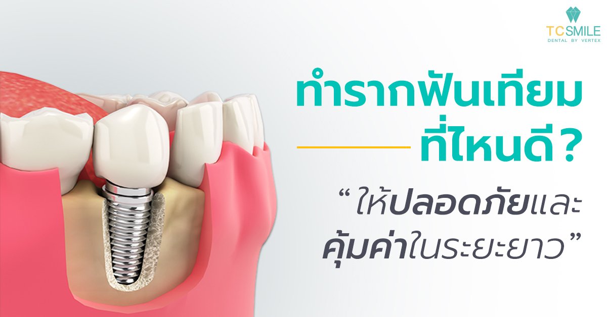 ทำรากฟันเทียมที่ไหนดี ให้ปลอดภัยและคุ้มค่าในระยะยาว