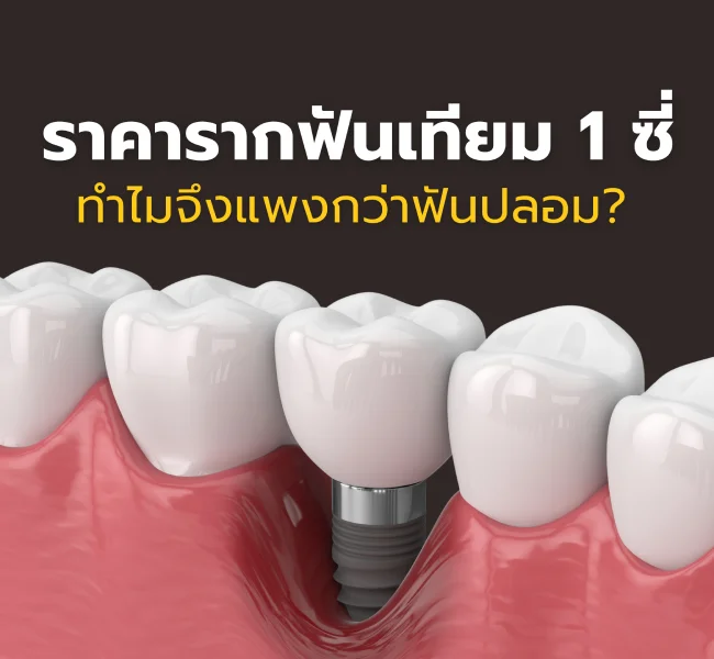 ราคารากฟันเทียม 1 ซี่