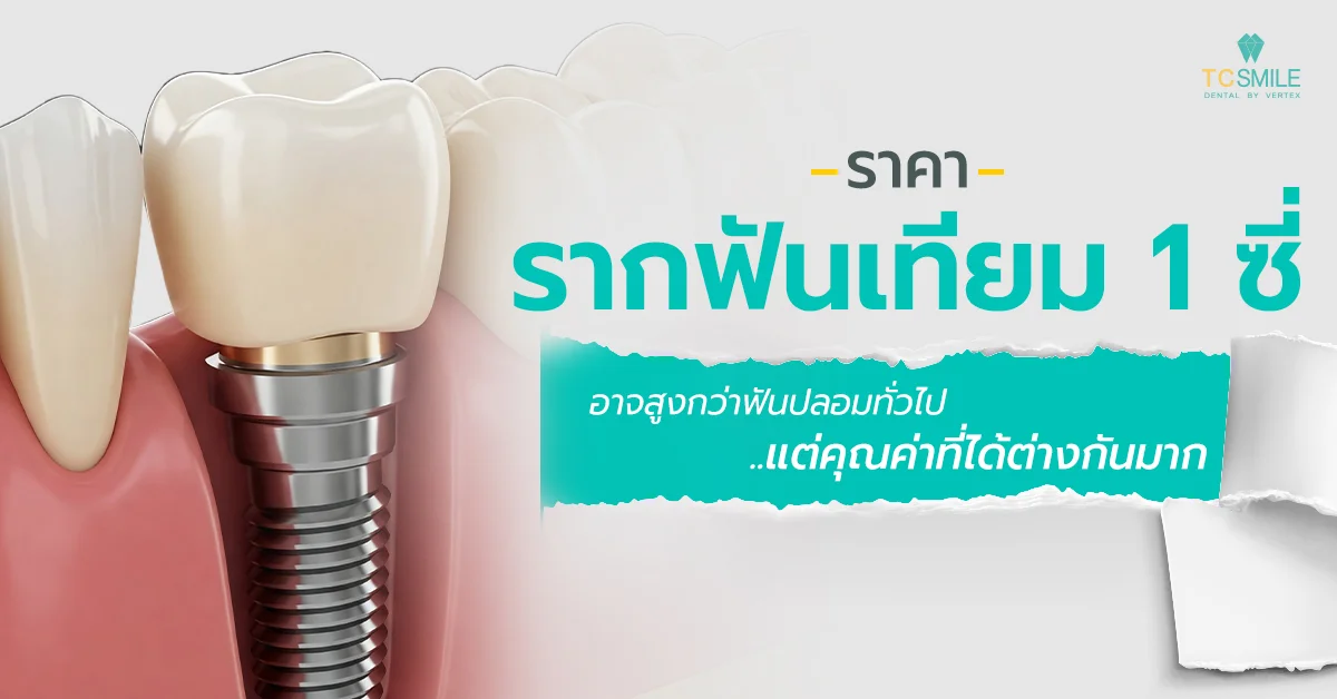 ราคารากฟันเทียม 1 ซี่