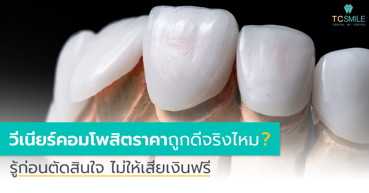วีเนียร์คอมโพสิตราคาถูกดีจริงไหม รู้ก่อนตัดสินใจ ไม่ให้เสียเงินฟรี