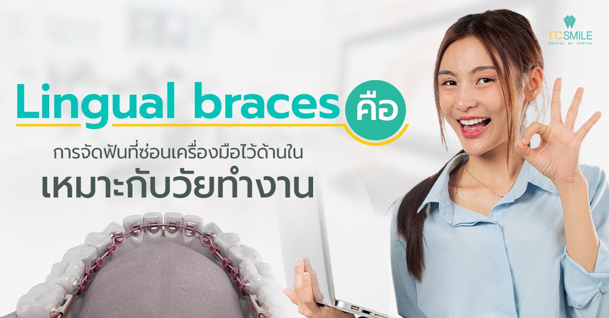Lingual braces คือ การจัดฟันที่ซ่อนเครื่องมือไว้ด้านใน เหมาะกับวัยทำงาน