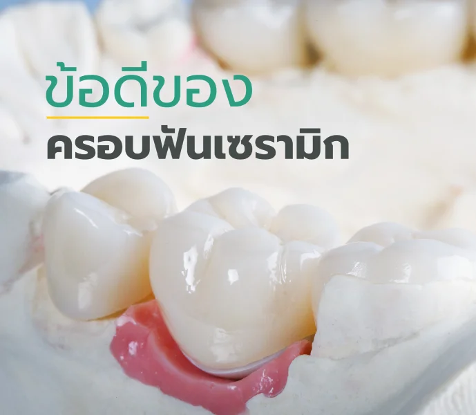 ข้อดีของครอบฟันเซรามิก