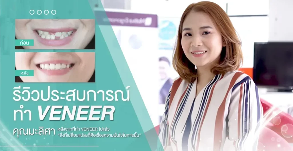 รีวิวประสบการณ์-ทำ-VENEER