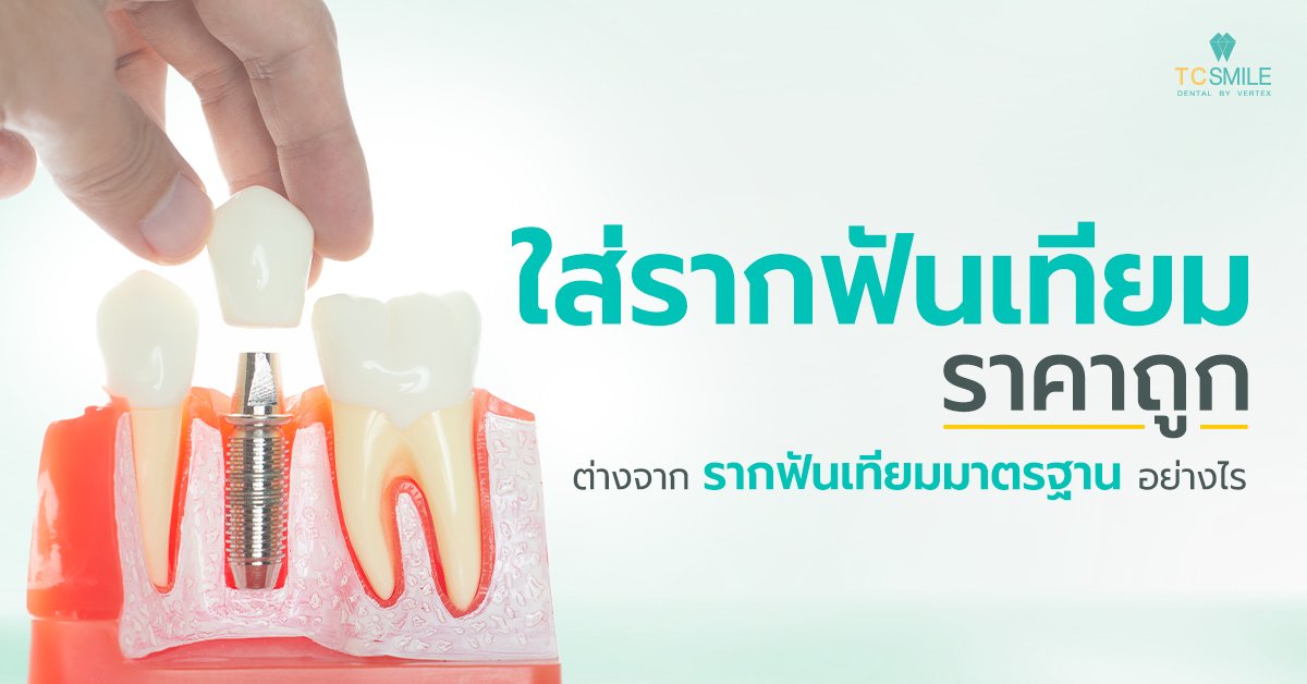 ใส่รากฟันเทียมราคาถูกต่างจากรากฟันเทียมมาตรฐานอย่างไร