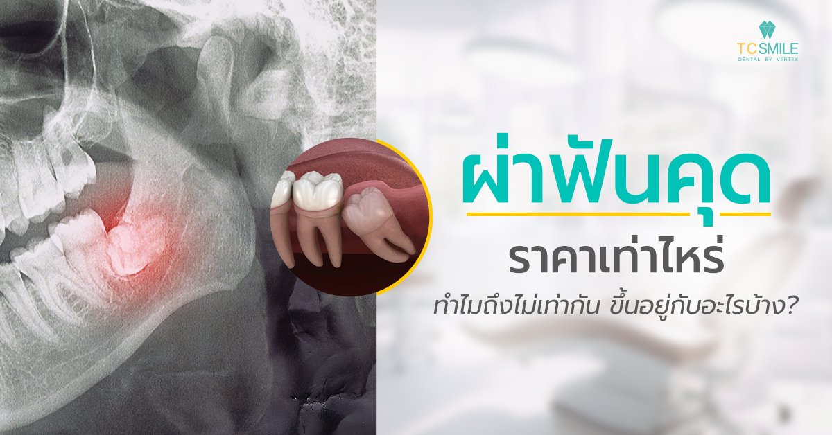 ผ่าฟันคุดราคาเท่าไหร่ ทำไมถึงไม่เท่ากัน ขึ้นอยู่กับอะไรบ้าง?