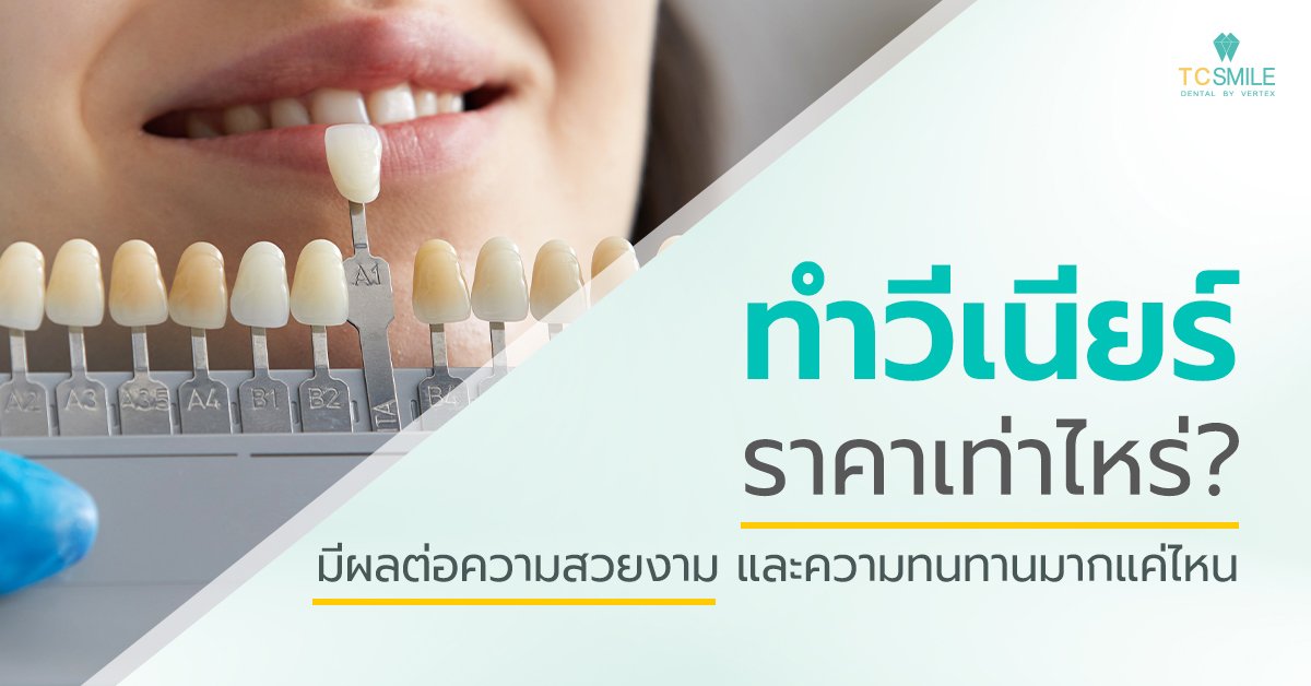 การทำวีเนียร์ราคาเท่าไหร่ มีผลต่อความสวยงามและความทนทานมากแค่ไหน