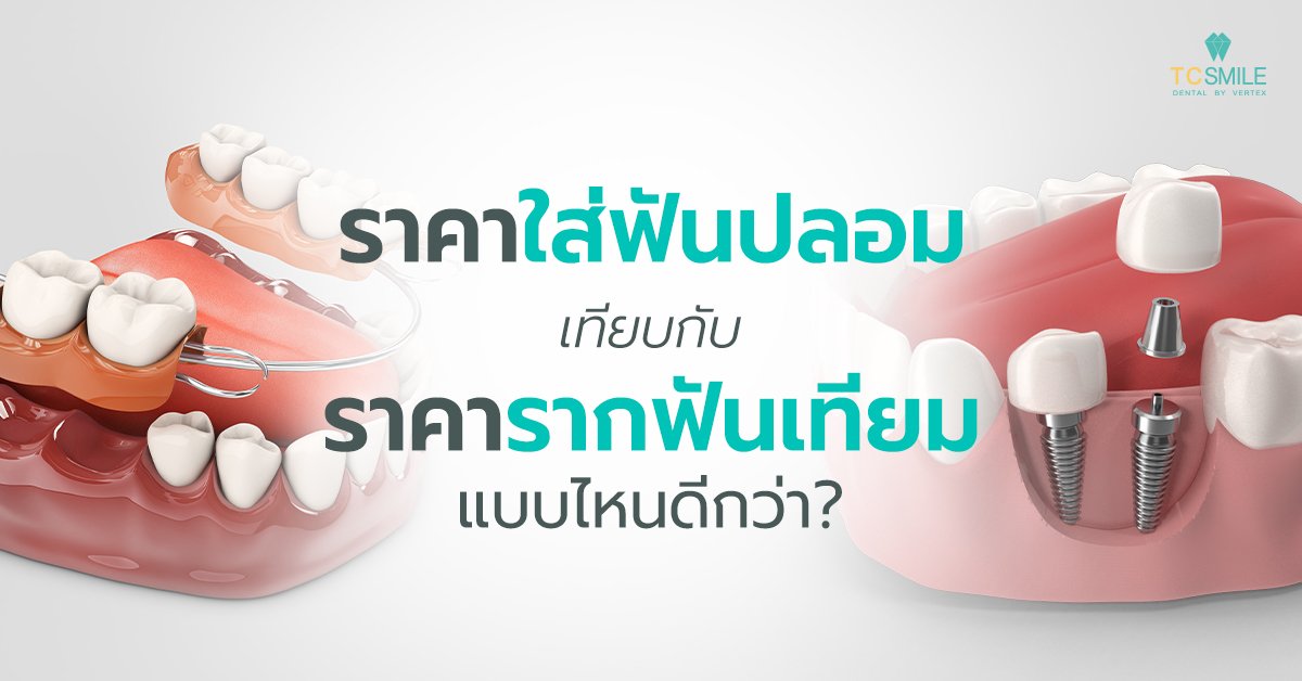 ราคาการใส่ฟันปลอมเท่าไหร่ เมื่อเทียบกับการทำรากฟันเทียม แบบไหนดีกว่ากัน
