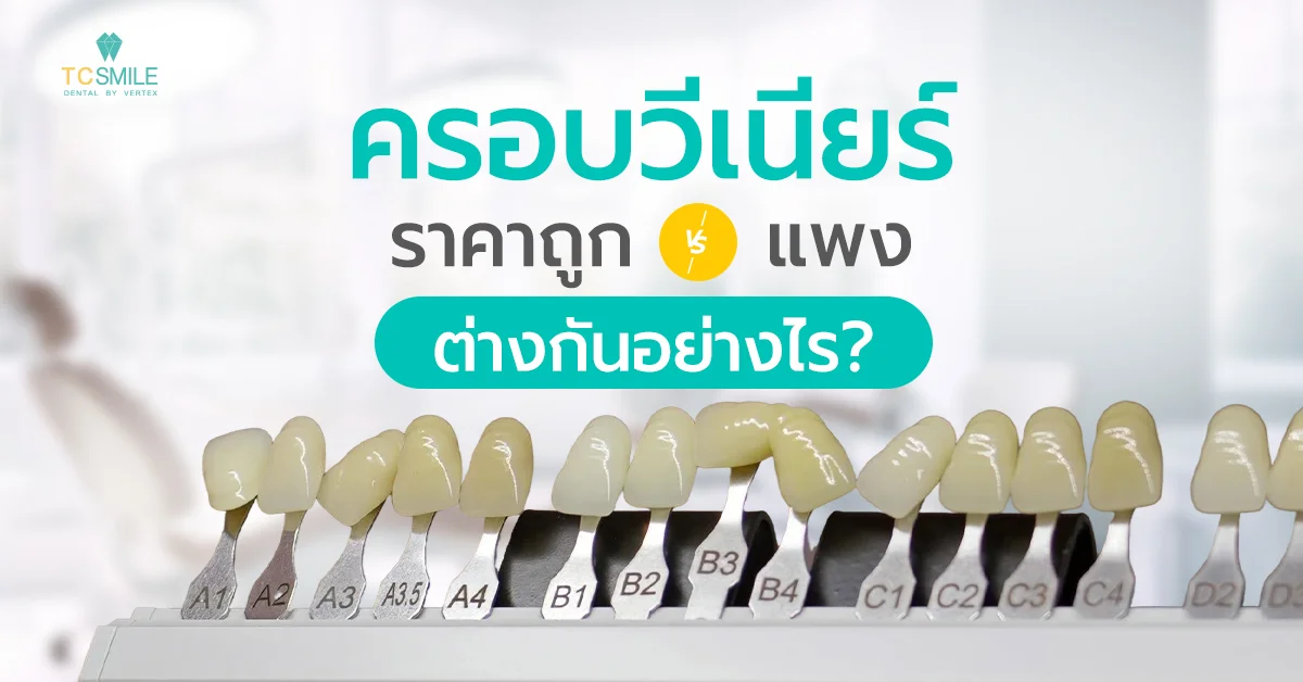 ครอบวีเนียร์ราคา ถูก vs แพง